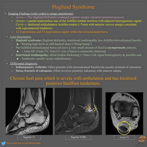1 an isolated haglund's deformity can lead to posterior heel pain in runners due to adjacent soft traditional radiographic parameters one would use to measure haglund's deformity on plain films. Haglund Syndrome - MSK Radiology Imaging Findings ...