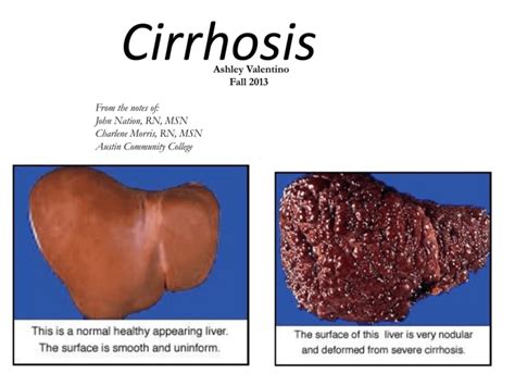 Cirrhosis Ppt Print And Bring To Class