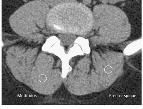 The back anatomy includes the latissimus dorsi, trapezius, erector spinae, rhomboid, and the teres significant. The CT image of paraspinal muscles. The circles illustrate ...