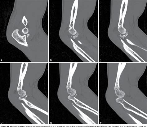 Figure 2 From Management Of Terrible Triad Injuries Of The Elbow