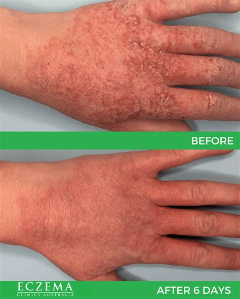 Eczema Before And After Treatment Eczema Clinics Australia