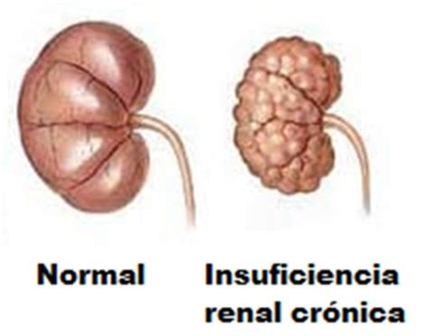 O diagnóstico da insuficiência renal é realizado a partir da observação de alguns sintomas e realização de exames laboratoriais. INSUFICIÊNCIA RENAL CRONICA