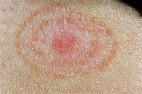 Ringworm Tinea Fungal Skin Infection Stock Image C0117541