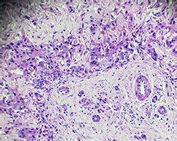 It usually affects the lining of the lungs, but also can affect the membranes around the heart or abdominal organs. Mesothelioma Cells: Sarcomatoid, Epithelial & Biphasic