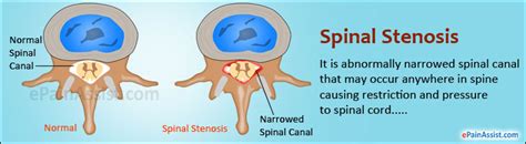 Spinal Stenosistypescausessignssymptomstreatmentpathophysiology