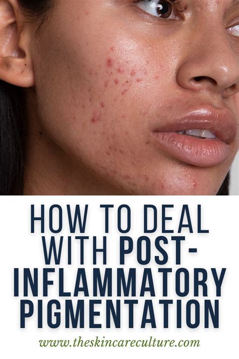 What Is Post Inflammatory Pigmentation Pih In Skincare Post