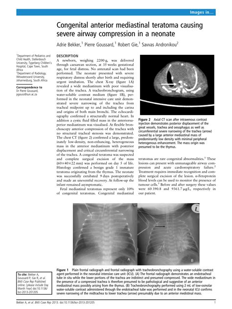Pdf Congenital Anterior Mediastinal Teratoma Causing Severe Airway