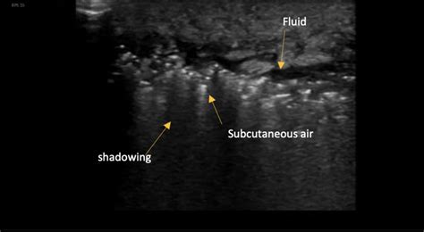 Soft Tissue Infection Diagnosis By Ultrasound — Brown Emergency Medicine