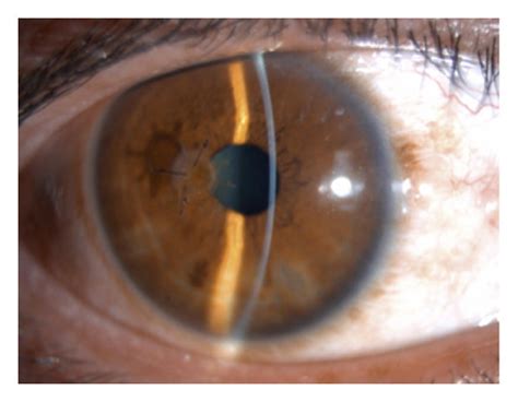 Penetrating Keratoplasty And Corneal Patching For Corneal Perforation