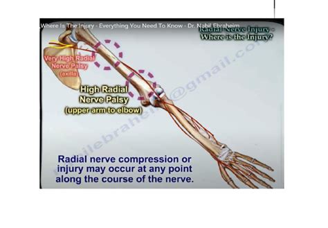 How To Localise Radial Nerve Injury —