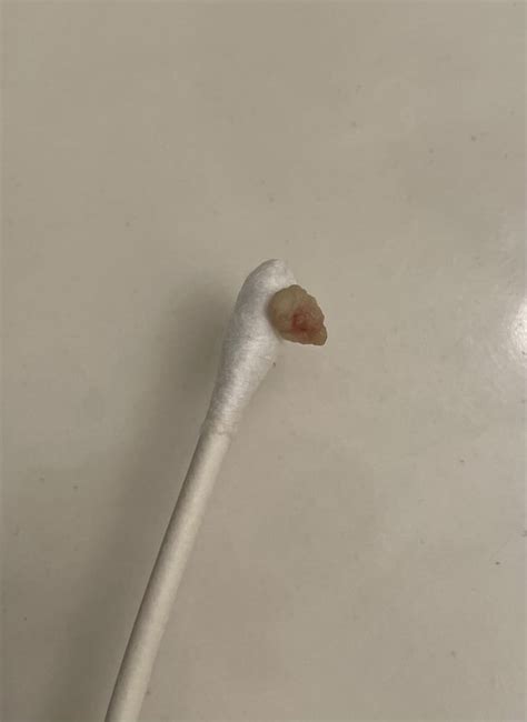 Juicy Tonsil Stone I Just Popped Out Rpopping