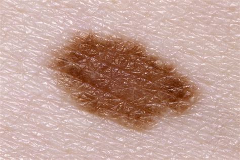 Skin Cancer Melanoma Symptoms Nhs