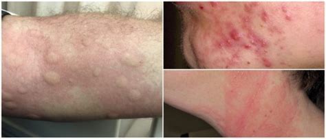 Atopic Dermatitis Skin Symptoms Icd 10 Symptoms Atopic Dermatitis