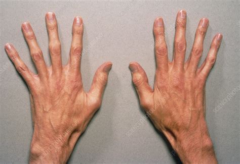 Marfan's syndrome - Stock Image - M210/0017 - Science Photo Library
