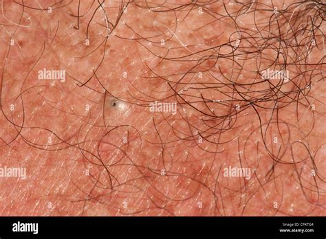 A forming Blackhead on chest Stock Photo, Royalty Free Image: 48379524