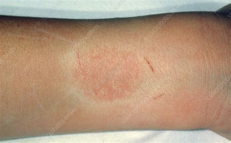 Contact Dermatitis Wristwatch Allergy Stock Image M1400109