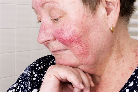 Rosacea Definition Facts Causes And Treatments