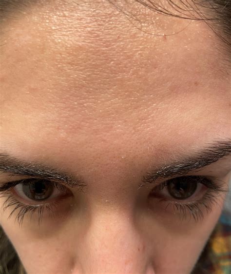 Skin Concerns Help W Scaly Patch On Forehead Rskincareaddiction