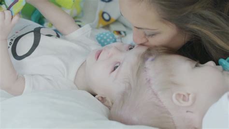 New Life Apart Conjoined Twins Separate And Undergo Surgery As