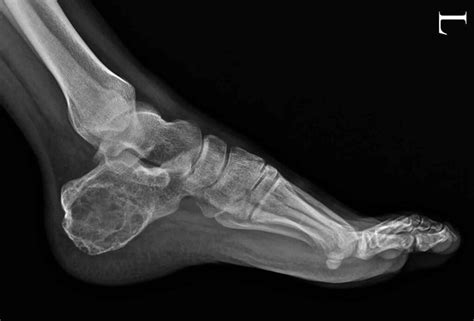 Aneurysmal Bone Cyst Causes Symptoms Diagnosis Treatment Recurrence