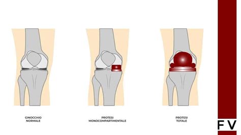 Protesi Al Ginocchio Durata Dellintervento