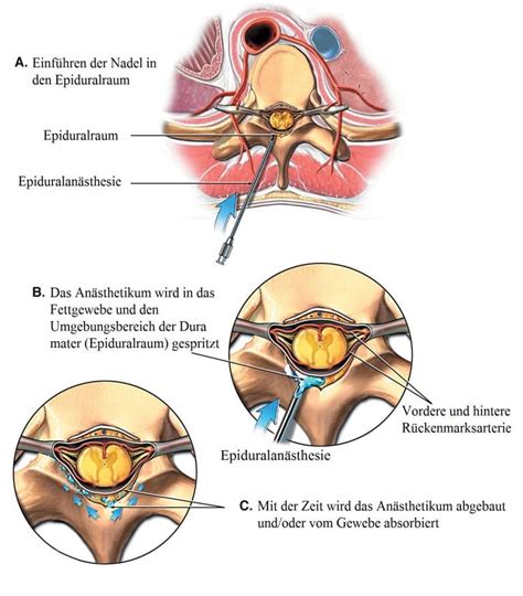Wie lange dauert eine kürettage? Ausschabung, Fehlgeburt, Periode, nach, Schwanger, Ablauf ...