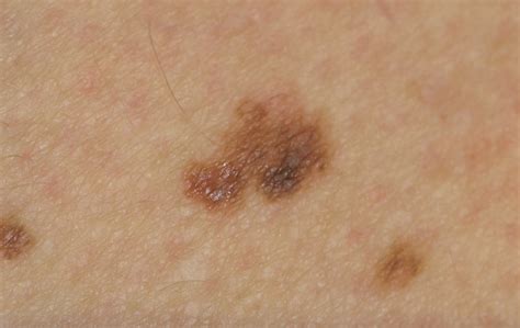 Managing Non Melanoma Skin Cancer In Primary Care A Focus On Topical