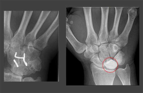 Carpal bone fractures