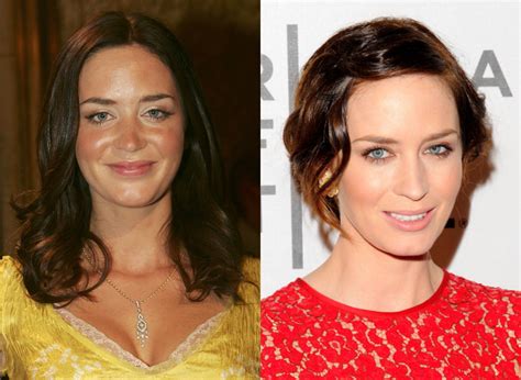 Emily Blunt Plastic Surgery - Celebrity Plastic Surgery