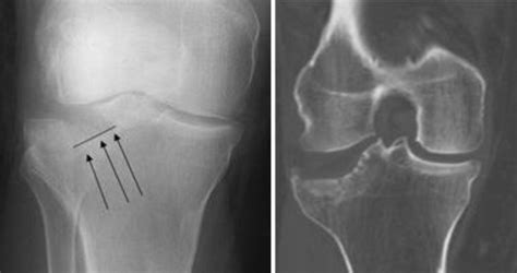 Fractures Of The Proximal Tibia Shinbone Orthoinfo Aaos