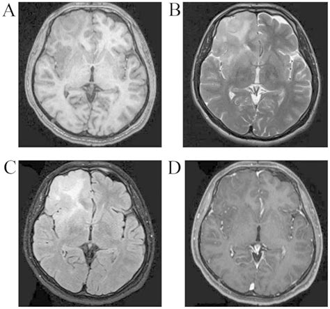 Clinical characteristics, treatment and prognosis of angiocentric glioma