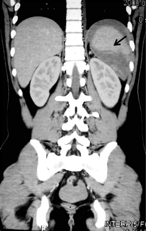 Ct Scan Axial Cuts Showing Peri Splenic Fluid Collection Bleed And