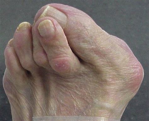 What To Expect From Hammertoe Surgery Quality Foot Care