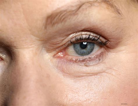 Eyelid Lumps And Bumps Removal Chicago Oculofacial