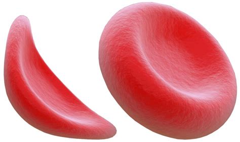 Sickle Cell Anemia Patients Can Live Normal Lives The San Diego Union