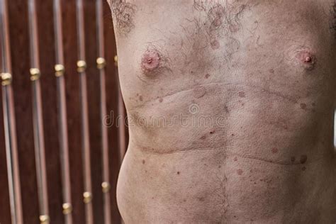 Ringworm On The Body Stock Photo Image Of Caused Infection 117936752