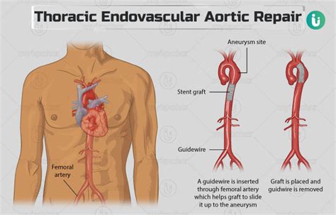 Thoracic Endovascular Aortic Repair TEVAR Procedure Purpose