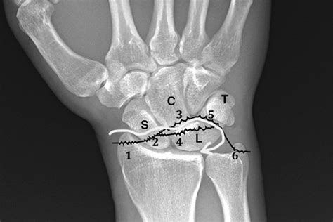 Dislocation Wrist Transscaphoid Perilunate Hand Surgery Resource