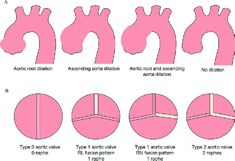 Aortic Dilation Phenotypes And Bicuspid Aortic Valve Bav Morphotypes Download Scientific