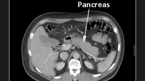 Normal Pancreas Cat Scan