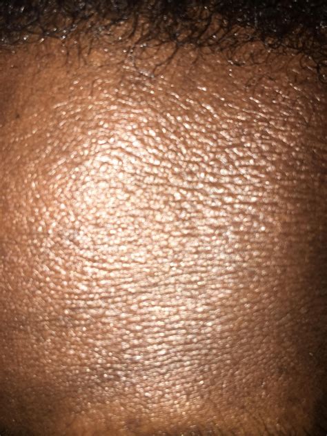 Skin Concerns I Have Dragon Scale Skin All Over My Forehead Its Been