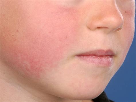 Fifth Disease: Causes, Diagnosis, and Treatment - 3Meds.com