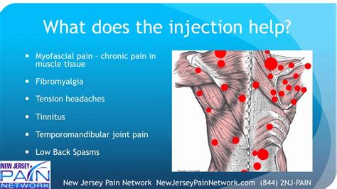 Overview Of Trigger Point Injections Explained By A Nj Pain Clinic