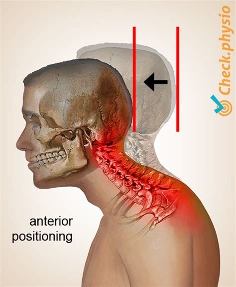 Cervical Posture Syndrome Physio Check