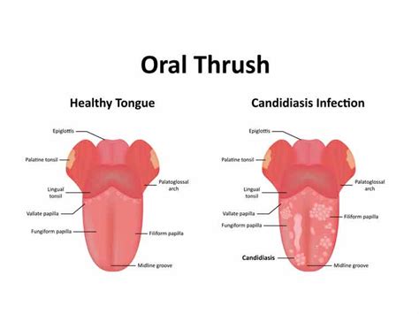 I was just wondering if it were possible to have a yeast infection without the white discharge? Yeast infections: have you got one? - Saga