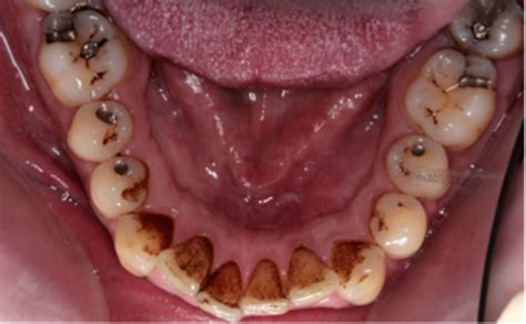 how to get rid of coffee stains on your teeth how to remove coffee stains from teeth with