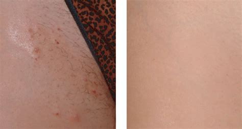 Laser Hair Removal Lakeshore Vein And Aesthetics Clinic Pre And Post
