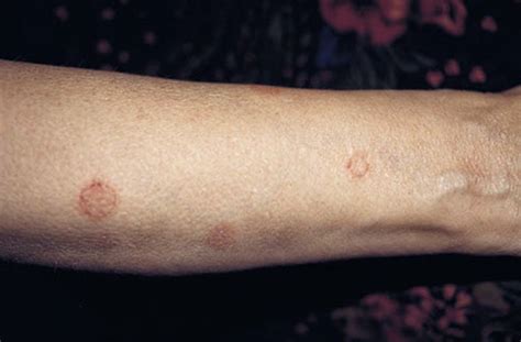 Nummular Eczema Pictures Symptoms Treatment Causes My Xxx Hot Girl