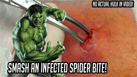 Hulks Spider Bite Is It Infected Cellulitis Youtube