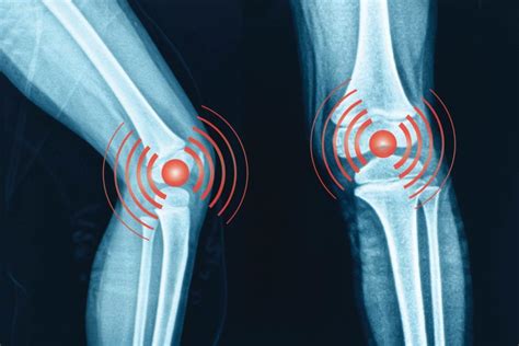 Radiographic Knee Osteoarthritis Increases Risk Of Early Death